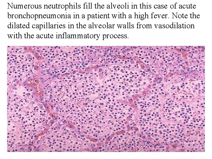 Numerous neutrophils fill the alveoli in this case of acute bronchopneumonia in a patient