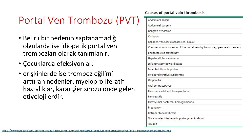 Portal Ven Trombozu (PVT) • Belirli bir nedenin saptanamadığı olgularda ise idiopatik portal ven