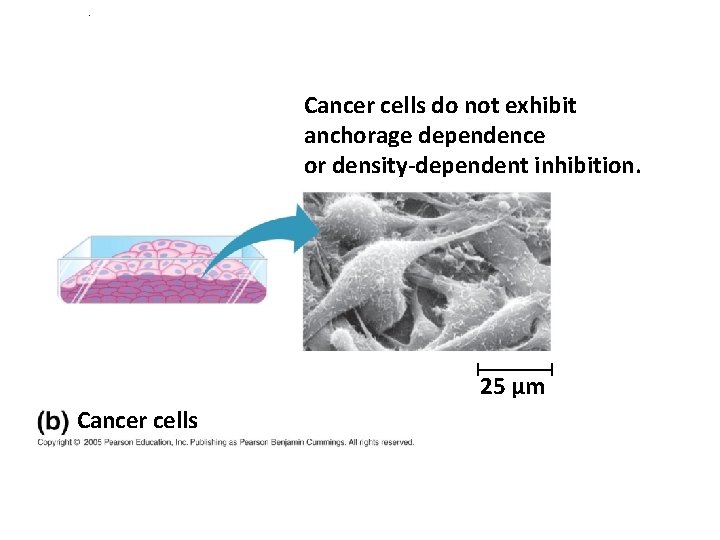 . Cancer cells do not exhibit anchorage dependence or density-dependent inhibition. 25 µm Cancer . Cancer cells do not exhibit anchorage dependence or density-dependent inhibition. 25 µm Cancer