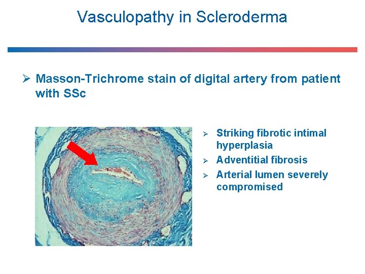 Vasculopathy in Scleroderma Ø Masson-Trichrome stain of digital artery from patient with SSc Ø