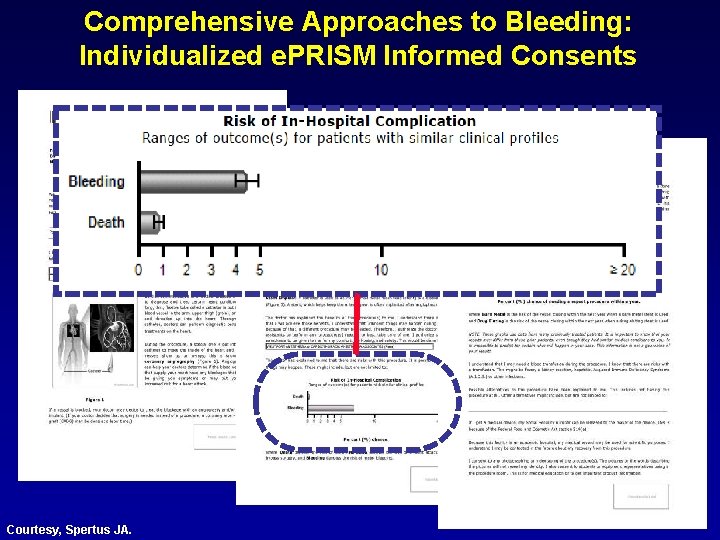 Comprehensive Approaches to Bleeding: Individualized e. PRISM Informed Consents Courtesy, Spertus JA. 
