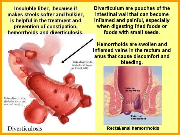 Insoluble fiber, because it makes stools softer and bulkier, is helpful in the treatment