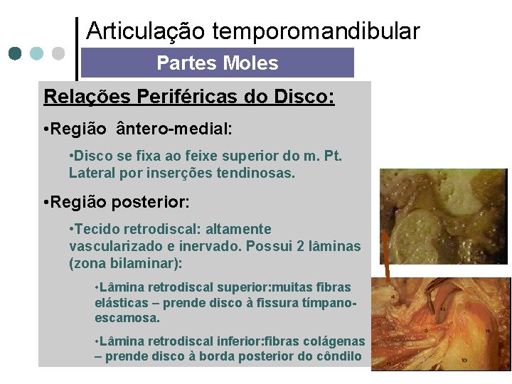 Articulação temporomandibular Partes Moles Relações Periféricas do Disco: • Região ântero-medial: • Disco se
