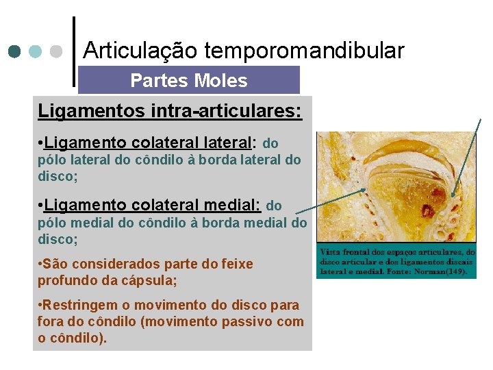 Articulação temporomandibular Partes Moles Ligamentos intra-articulares: • Ligamento colateral: do pólo lateral do côndilo