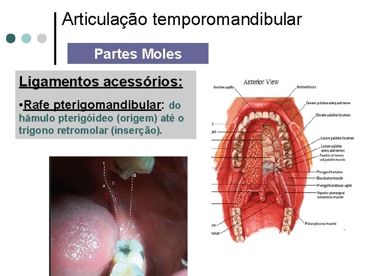 Articulação temporomandibular Partes Moles Ligamentos acessórios: • Rafe pterigomandibular: do hâmulo pterigóideo (origem) até