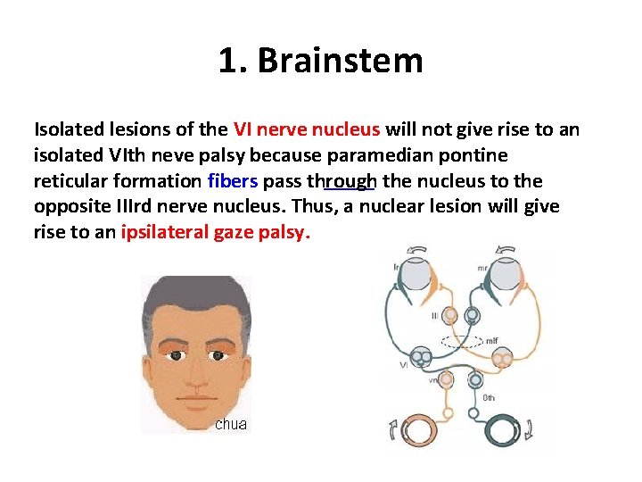 1. Brainstem Isolated lesions of the VI nerve nucleus will not give rise to