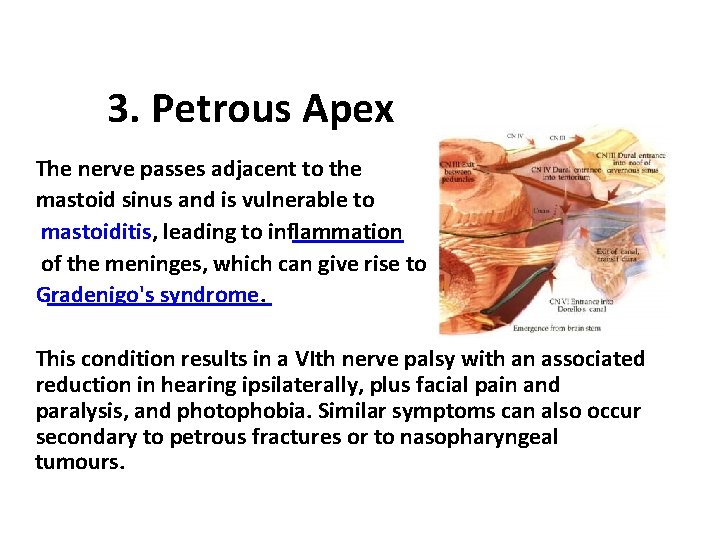 3. Petrous Apex The nerve passes adjacent to the mastoid sinus and is vulnerable