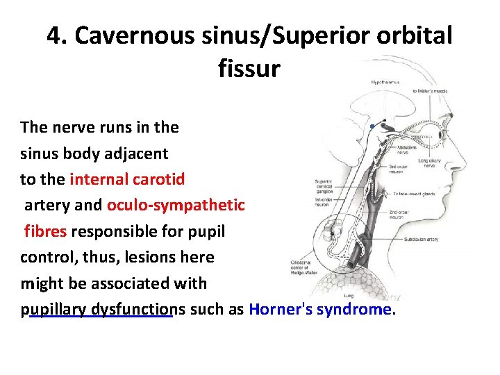 4. Cavernous sinus/Superior orbital fissure The nerve runs in the sinus body adjacent to