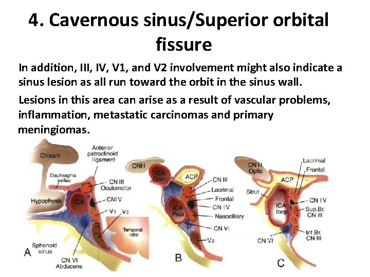 4. Cavernous sinus/Superior orbital fissure In addition, III, IV, V 1, and V 2