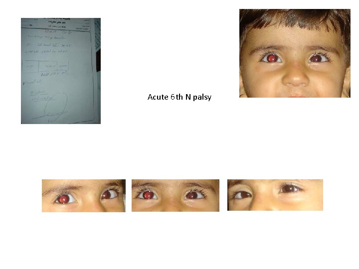 Acute 6 th N palsy 