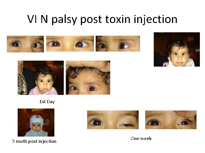 VI N palsy post toxin injection 1 st Day 5 moth post injection One