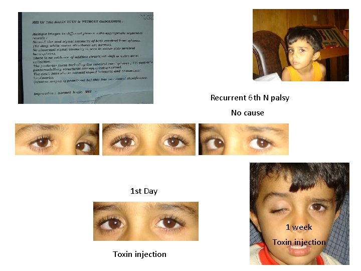 Recurrent 6 th N palsy No cause 1 st Day 1 week Toxin injection