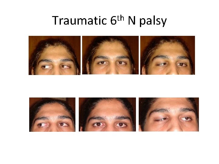 Traumatic 6 th N palsy 