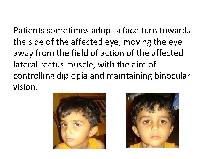 Patients sometimes adopt a face turn towards the side of the affected eye, moving