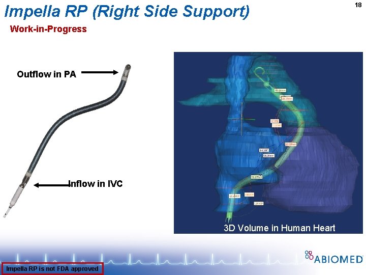 Impella RP (Right Side Support) Work-in-Progress Outflow in PA Inflow in IVC 3 D