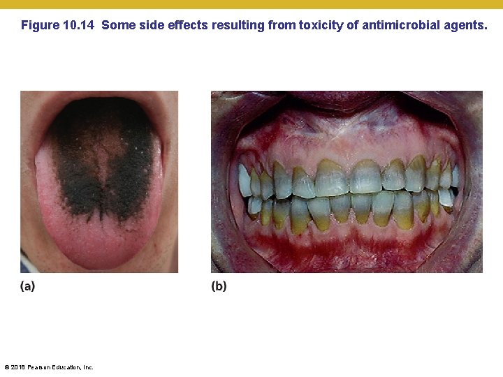 Figure 10. 14 Some side effects resulting from toxicity of antimicrobial agents. © 2018