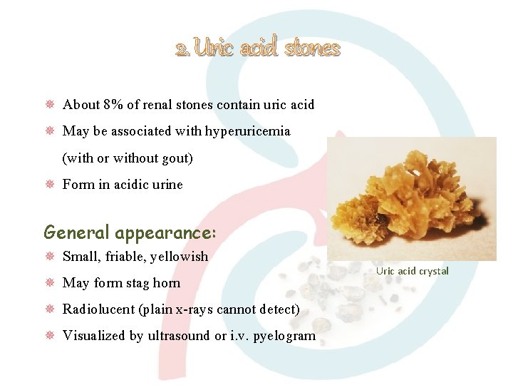 2. Uric acid stones About 8% of renal stones contain uric acid May be