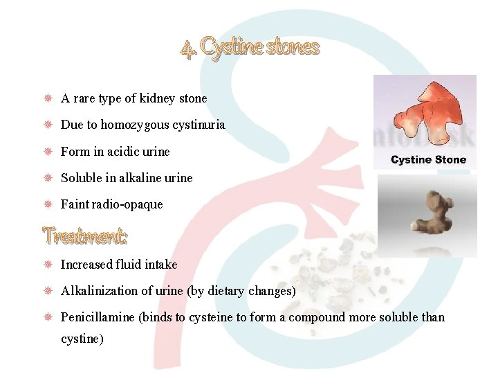 4. Cystine stones A rare type of kidney stone Due to homozygous cystinuria Form