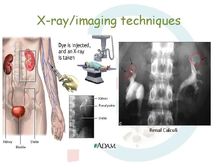 X-ray/imaging techniques Renal Calculi 