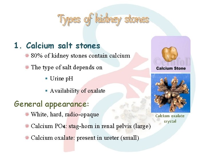 Types of kidney stones 1. Calcium salt stones 80% of kidney stones contain calcium