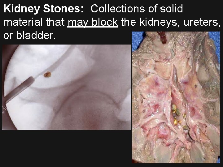 Kidney Stones: Collections of solid material that may block the kidneys, ureters, or bladder.