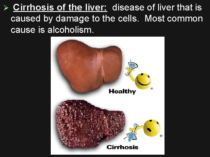 Ø Cirrhosis of the liver: disease of liver that is caused by damage to