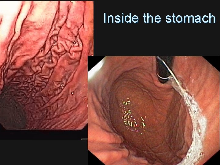 Inside the stomach 