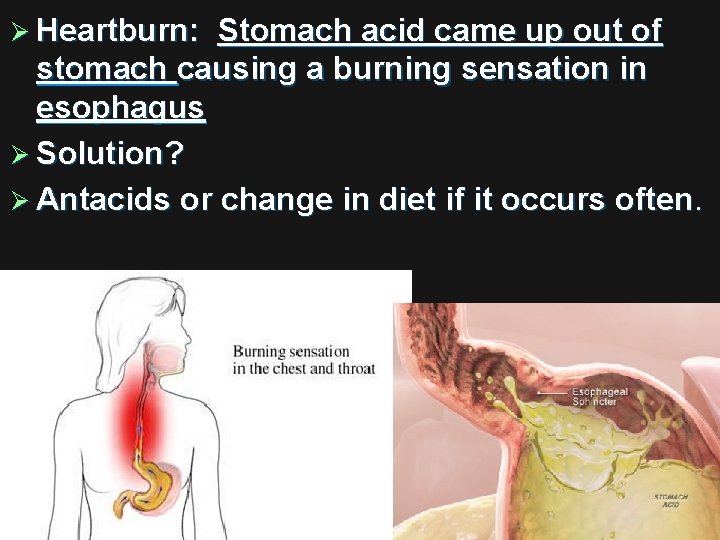 Ø Heartburn: Stomach acid came up out of stomach causing a burning sensation in