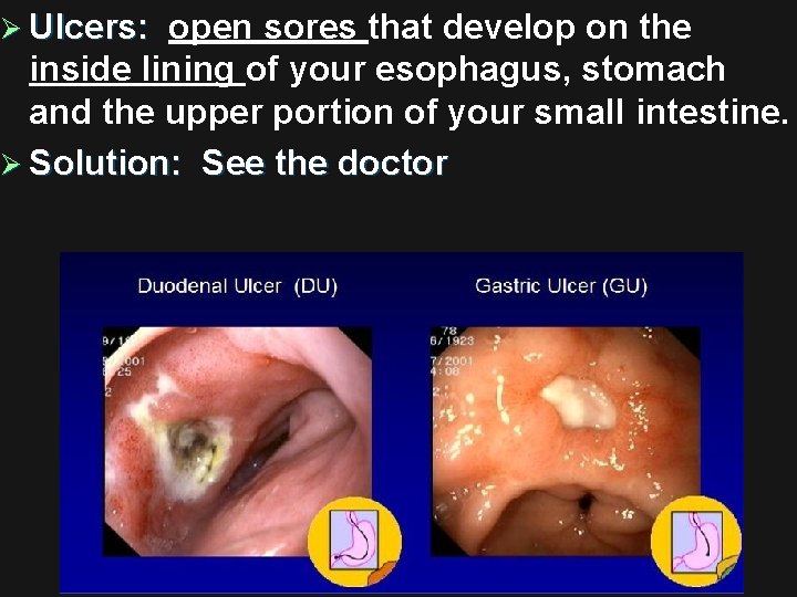 Ø Ulcers: open sores that develop on the Ulcers: inside lining of your esophagus,