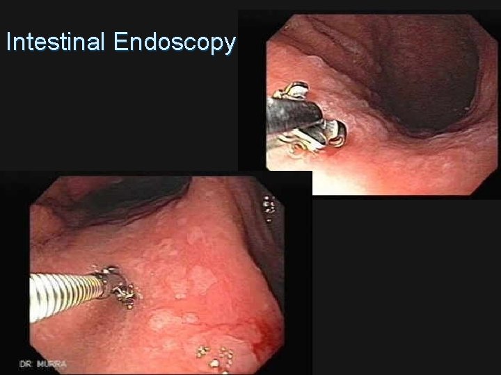 Intestinal Endoscopy 