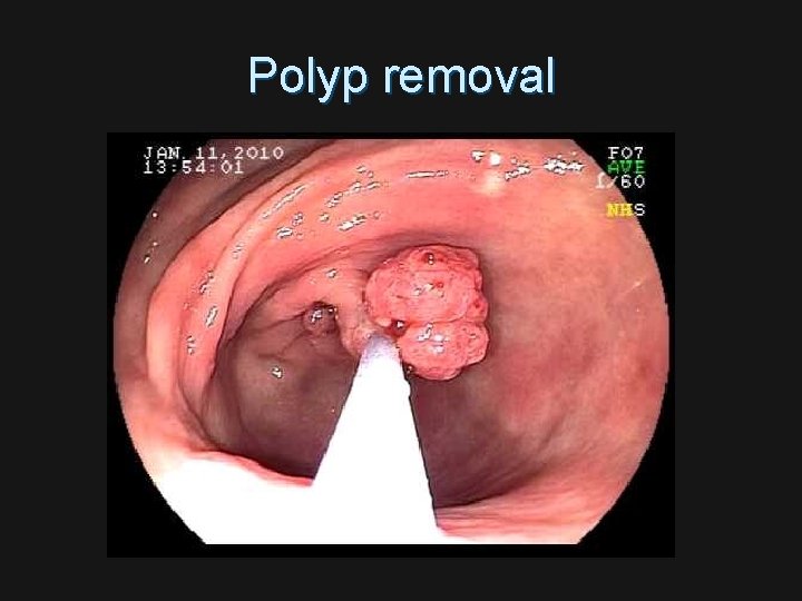 Polyp removal 