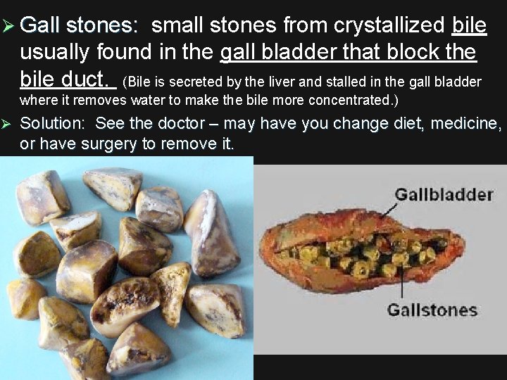 Ø Gall stones: small stones from crystallized bile Gall stones: usually found in the