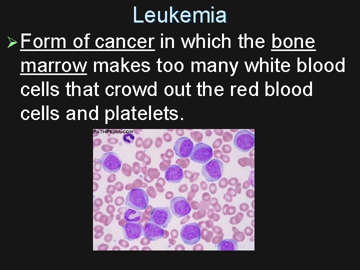 Leukemia Ø Form of cancer in which the bone marrow makes too many white