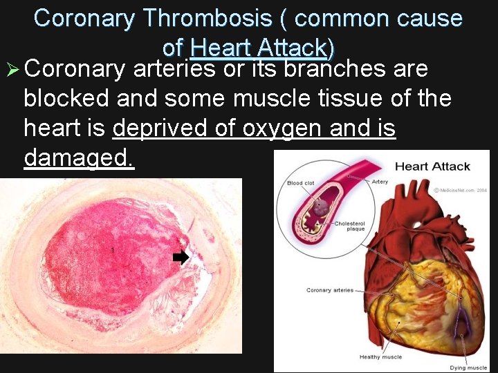 Coronary Thrombosis ( common cause of Heart Attack) Ø Coronary arteries or its branches
