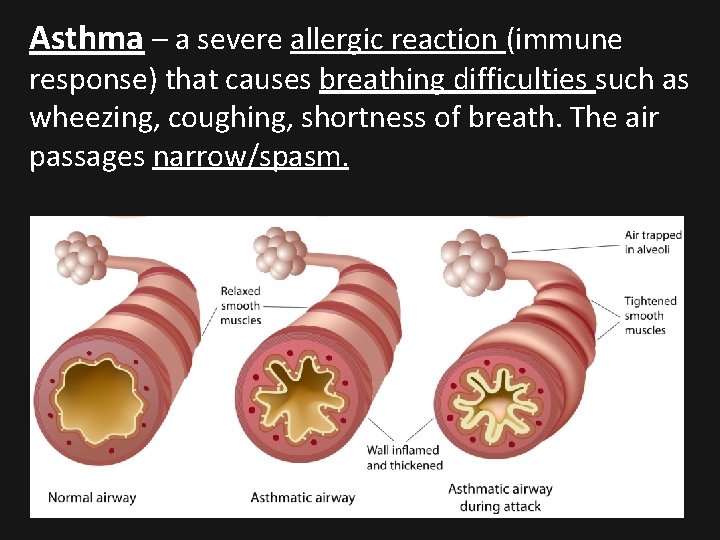 Asthma – a severe allergic reaction (immune response) that causes breathing difficulties such as