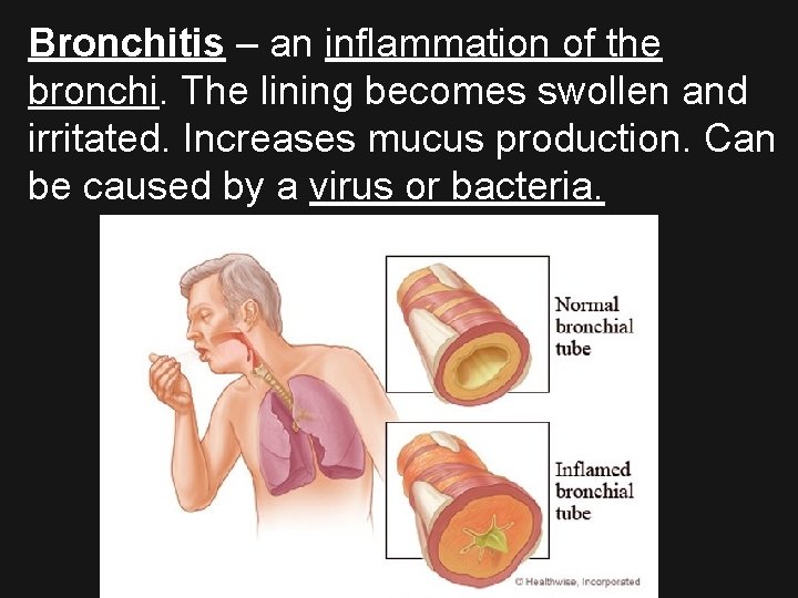 Bronchitis – an inflammation of the bronchi. The lining becomes swollen and irritated. Increases