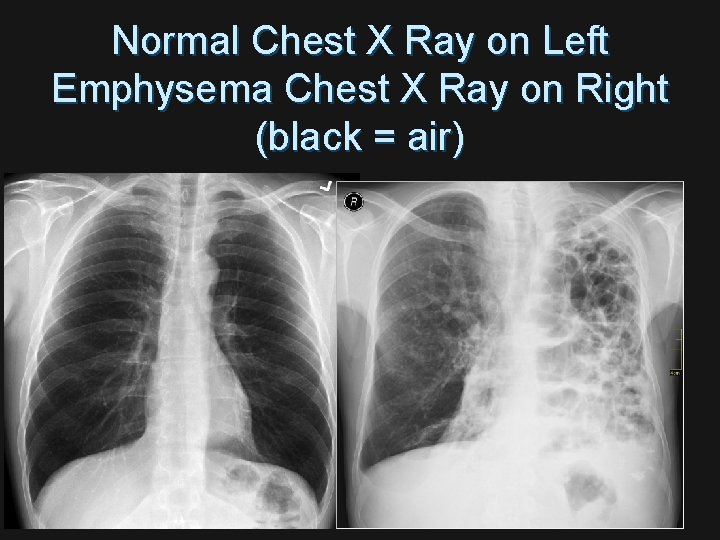 Normal Chest X Ray on Left Emphysema Chest X Ray on Right (black =