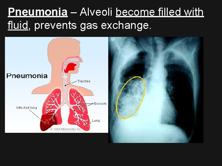 Pneumonia – Alveoli become filled with fluid, prevents gas exchange. 