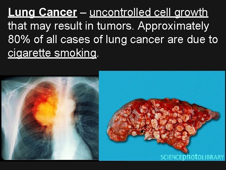 Lung Cancer – uncontrolled cell growth that may result in tumors. Approximately 80% of