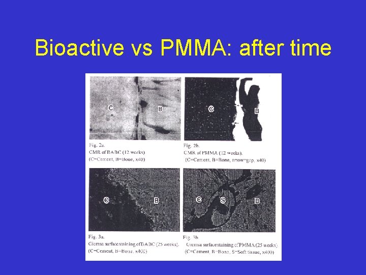 Bioactive vs PMMA: after time 