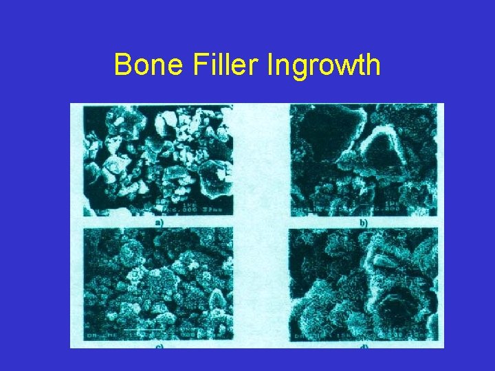 Bone Filler Ingrowth 