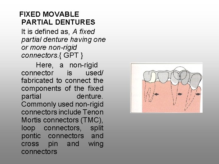 FIXED MOVABLE PARTIAL DENTURES It is defined as, A fixed partial denture having one