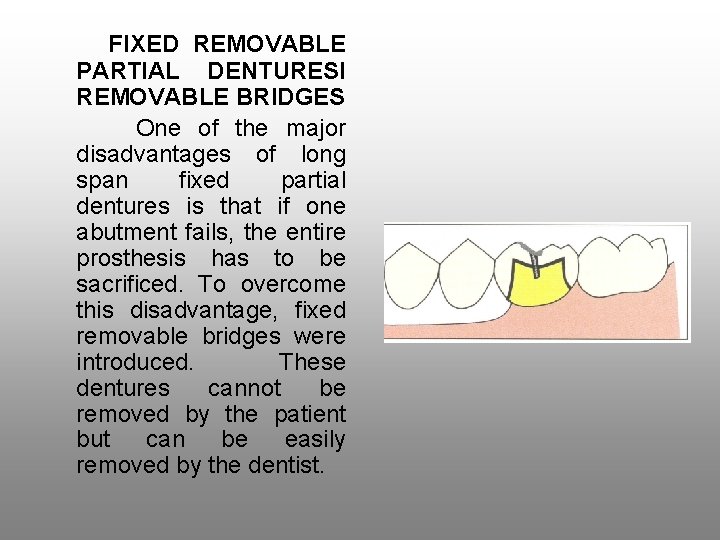 FIXED REMOVABLE PARTIAL DENTURESI REMOVABLE BRIDGES One of the major disadvantages of long span
