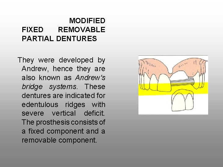 MODIFIED FIXED REMOVABLE PARTIAL DENTURES They were developed by Andrew, hence they are also