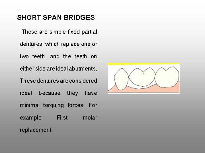 SHORT SPAN BRIDGES These are simple fixed partial dentures, which replace one or two