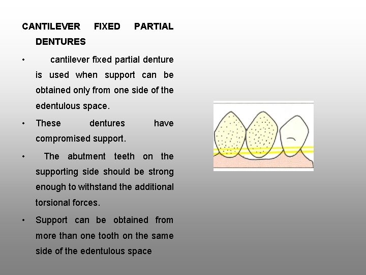 CANTILEVER FIXED PARTIAL DENTURES • cantilever fixed partial denture is used when support can