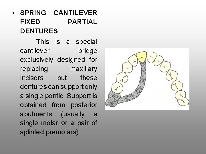  • SPRING CANTILEVER FIXED PARTIAL DENTURES This is a special cantilever bridge exclusively