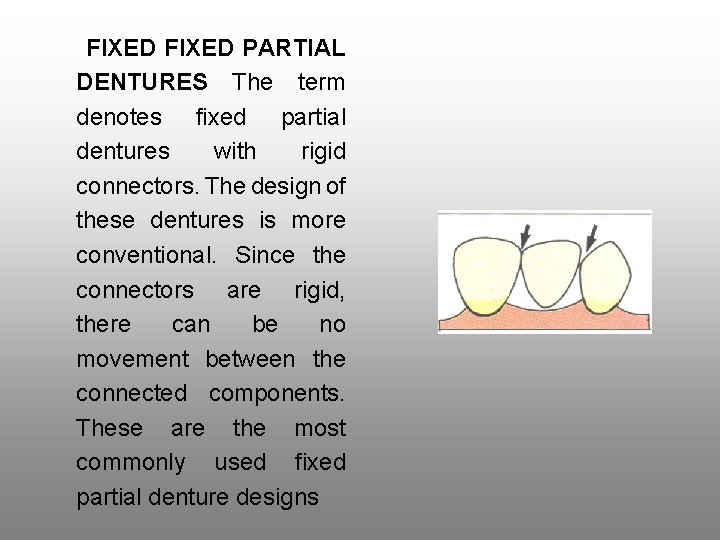 FIXED PARTIAL DENTURES The term denotes fixed partial dentures with rigid connectors. The design