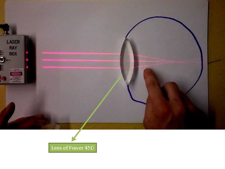 Lens of Power 45 D 