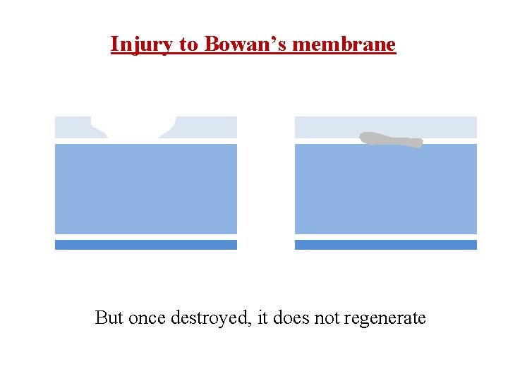 Injury to Bowan’s membrane But once destroyed, it does not regenerate 